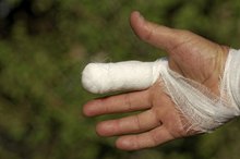 What is the Recovery Time for a Broken Finger in Baseball Players?