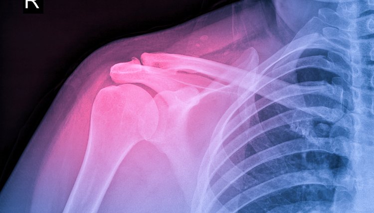 X-ray image of shoulder pain, shoulder ligament tendinitis, shoulder muscle strain