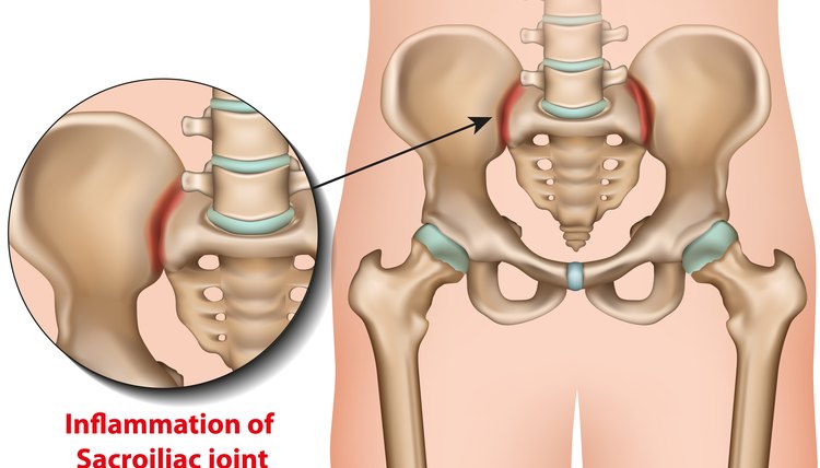 Sacroiliac joint inflammation 3d medical vector illustration sacroiliitis